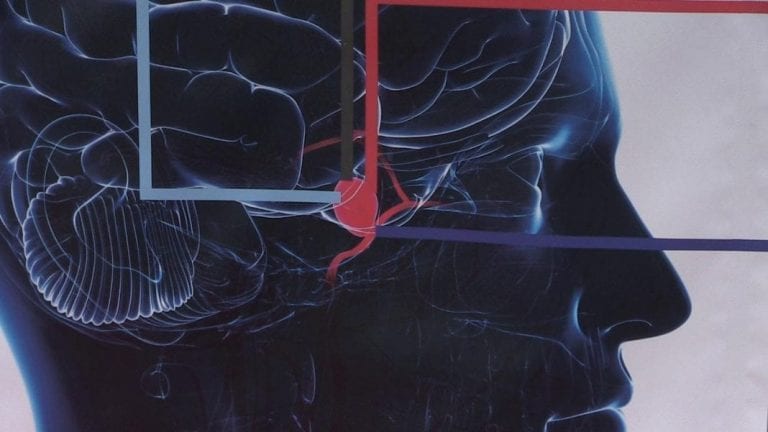 DAN ANEURIZME MOZGA: Jedna od 50 osoba ima nerupturiranu aneurizmu krvnih žila mozga