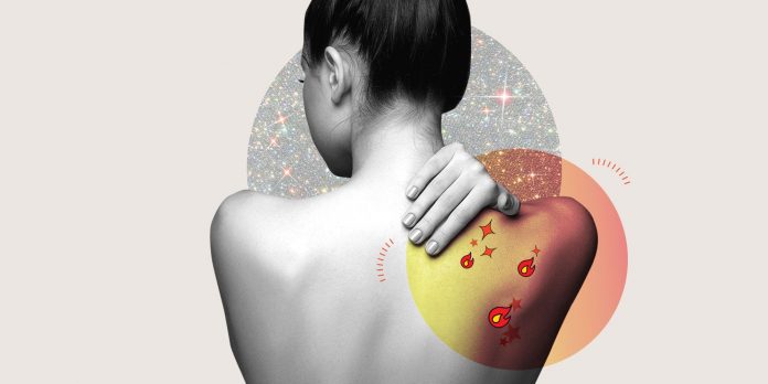 beauty-sunburn-1587053718